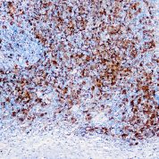 Immunohistochemical staining of Fascin-1  of human FFPE tissue followed by incubation with HRP labeled secondary and development with DAB substrate.