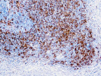 Immunohistochemical staining of Fascin-1  of human FFPE tissue followed by incubation with HRP labeled secondary and development with DAB substrate.