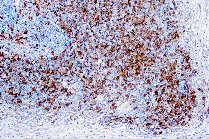 Immunohistochemical staining of Fascin-1  of human FFPE tissue followed by incubation with HRP labeled secondary and development with DAB substrate.