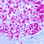 Immunohistochemical staining of Ki-67  of human FFPE tissue followed by incubation with HRP labeled secondary and development with DAB substrate.