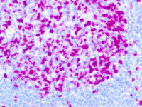 Immunohistochemical staining of Ki-67  of human FFPE tissue followed by incubation with HRP labeled secondary and development with DAB substrate.