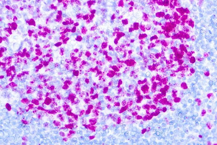 Immunohistochemical staining of Ki-67  of human FFPE tissue followed by incubation with HRP labeled secondary and development with DAB substrate.
