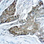 Immunohistochemical staining of Mammaglobin  of human FFPE tissue followed by incubation with HRP labeled secondary and development with DAB substrate.