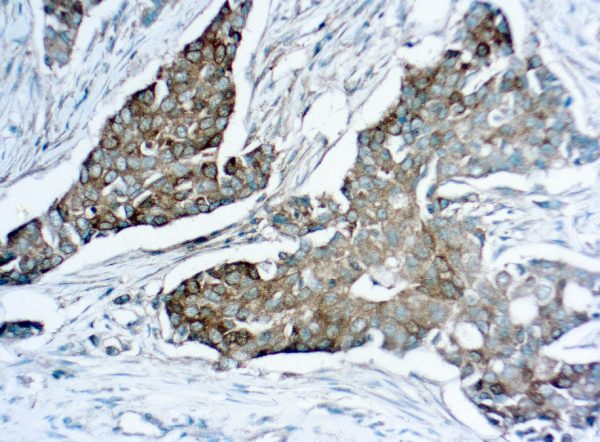 Immunohistochemical staining of Mammaglobin  of human FFPE tissue followed by incubation with HRP labeled secondary and development with DAB substrate.