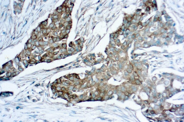 Immunohistochemical staining of Mammaglobin  of human FFPE tissue followed by incubation with HRP labeled secondary and development with DAB substrate.
