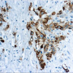 Immunohistochemical staining of Mesothelin  of human FFPE tissue followed by incubation with HRP labeled secondary and development with DAB substrate.