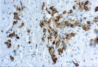 Immunohistochemical staining of Mesothelin  of human FFPE tissue followed by incubation with HRP labeled secondary and development with DAB substrate.