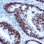 Immunohistochemical staining of MLH-1  of human FFPE tissue followed by incubation with HRP labeled secondary and development with DAB substrate.