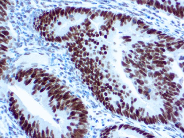 Immunohistochemical staining of MLH-1  of human FFPE tissue followed by incubation with HRP labeled secondary and development with DAB substrate.