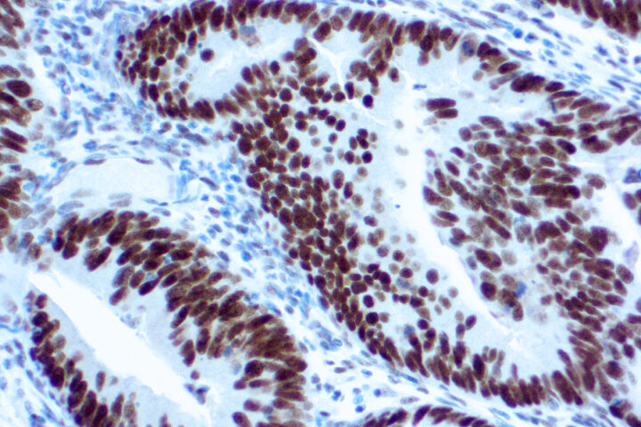 Immunohistochemical staining of MLH-1  of human FFPE tissue followed by incubation with HRP labeled secondary and development with DAB substrate.