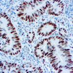 Immunohistochemical staining of MSH6  of human FFPE tissue followed by incubation with HRP labeled secondary and development with DAB substrate.