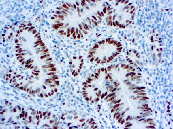 Immunohistochemical staining of MSH6  of human FFPE tissue followed by incubation with HRP labeled secondary and development with DAB substrate.