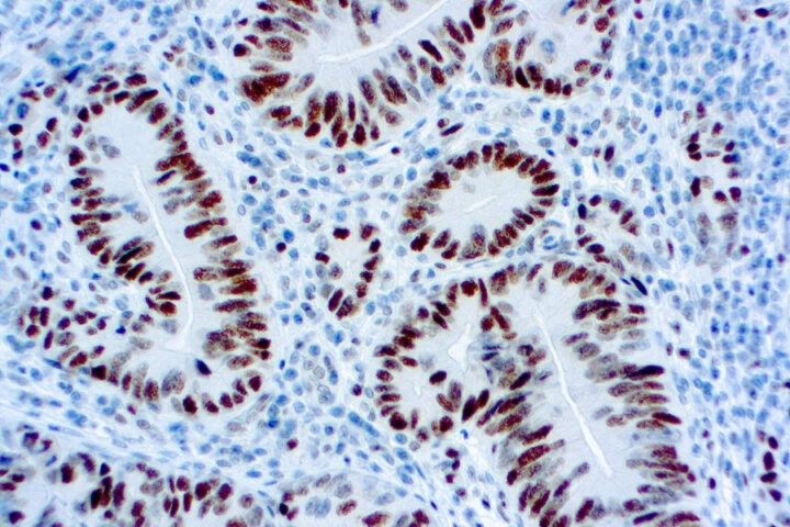 Immunohistochemical staining of MSH6  of human FFPE tissue followed by incubation with HRP labeled secondary and development with DAB substrate.