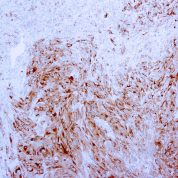 Immunohistochemical staining of MART-1/Melan-A, Melanoma Marker  of human FFPE tissue followed by incubation with HRP labeled secondary and development with DAB substrate.