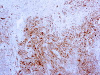 Immunohistochemical staining of MART-1/Melan-A, Melanoma Marker  of human FFPE tissue followed by incubation with HRP labeled secondary and development with DAB substrate.