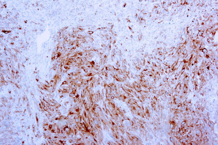 Immunohistochemical staining of MART-1/Melan-A, Melanoma Marker  of human FFPE tissue followed by incubation with HRP labeled secondary and development with DAB substrate.