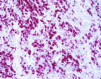 Immunohistochemical staining of MART-1  of human FFPE tissue followed by incubation with HRP labeled secondary and development with DAB substrate.