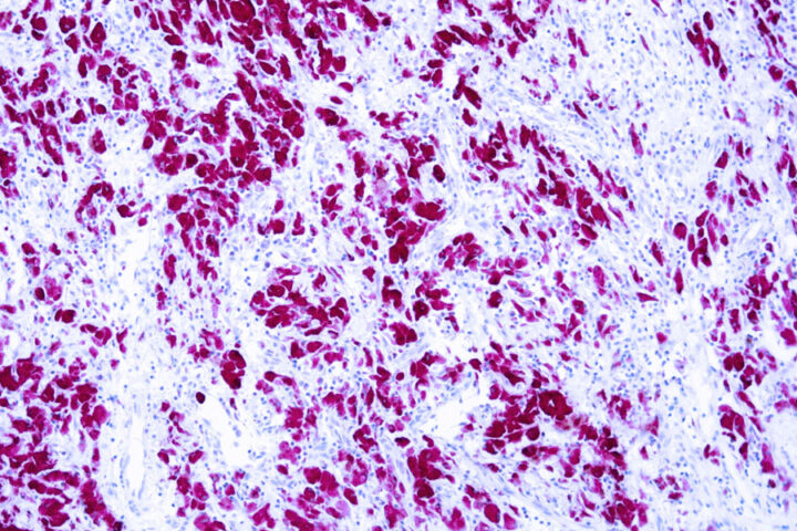 Immunohistochemical staining of MART-1  of human FFPE tissue followed by incubation with HRP labeled secondary and development with DAB substrate.