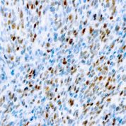 Immunohistochemical staining of MyoD1  of human FFPE tissue followed by incubation with HRP labeled secondary and development with DAB substrate.