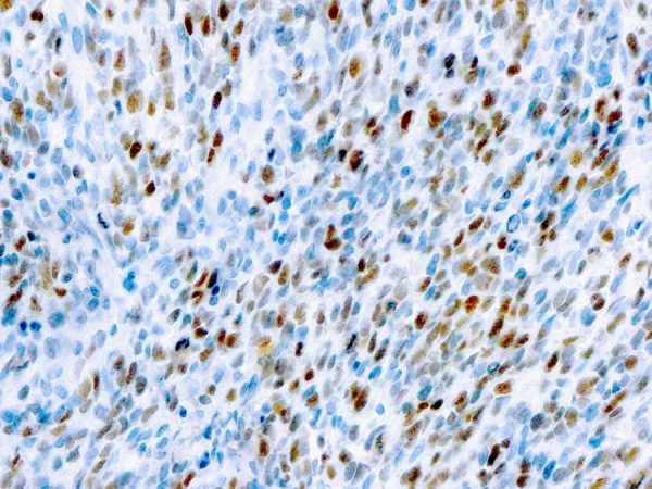 Immunohistochemical staining of MyoD1  of human FFPE tissue followed by incubation with HRP labeled secondary and development with DAB substrate.