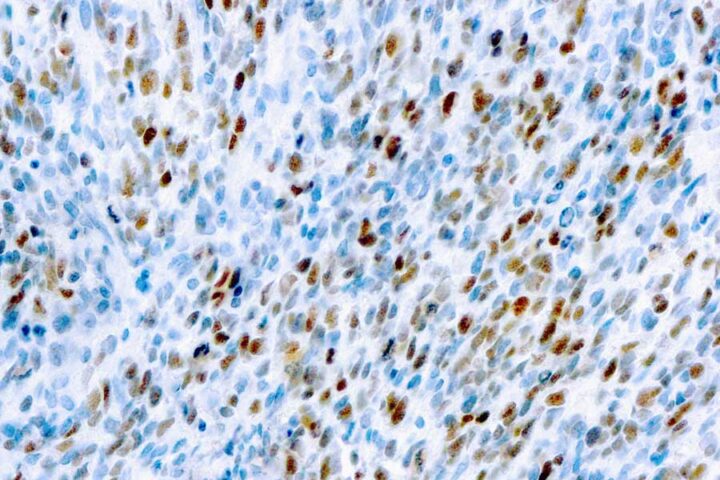 Immunohistochemical staining of MyoD1  of human FFPE tissue followed by incubation with HRP labeled secondary and development with DAB substrate.