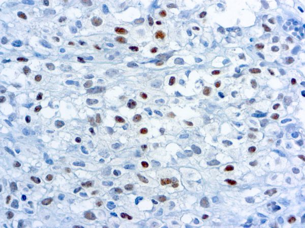 Immunohistochemical staining of Myogenin  of human FFPE tissue followed by incubation with HRP labeled secondary and development with DAB substrate.