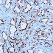 Immunohistochemical staining of Napsin A  of human FFPE tissue followed by incubation with HRP labeled secondary and development with DAB substrate.