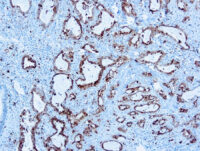 Immunohistochemical staining of Napsin A  of human FFPE tissue followed by incubation with HRP labeled secondary and development with DAB substrate.