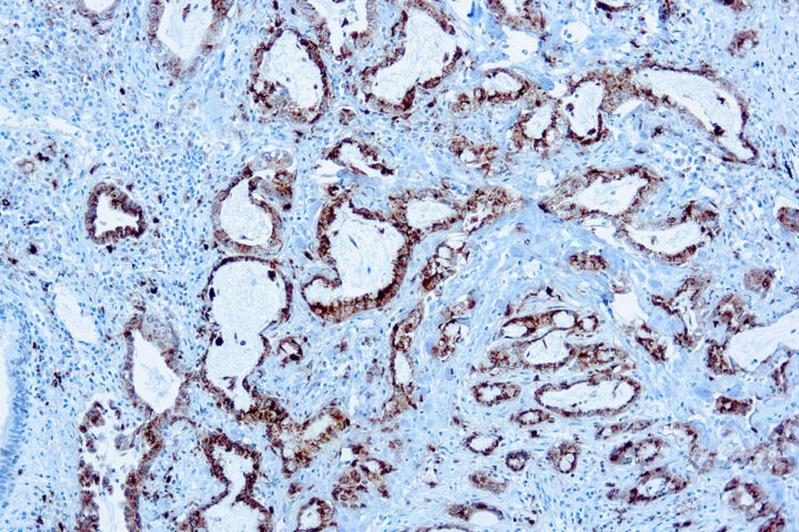 Immunohistochemical staining of Napsin A  of human FFPE tissue followed by incubation with HRP labeled secondary and development with DAB substrate.