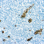 Immunohistochemical staining of O-Methylguanine-DNA-Methyltransferase  of human FFPE tissue followed by incubation with HRP labeled secondary and development with DAB substrate.