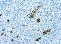 Immunohistochemical staining of O-Methylguanine-DNA-Methyltransferase  of human FFPE tissue followed by incubation with HRP labeled secondary and development with DAB substrate.