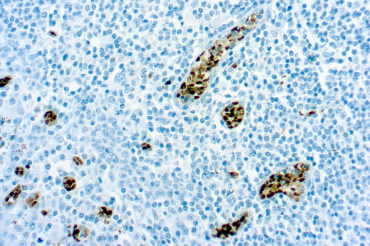 Immunohistochemical staining of O-Methylguanine-DNA-Methyltransferase  of human FFPE tissue followed by incubation with HRP labeled secondary and development with DAB substrate.