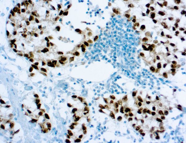 Immunohistochemical staining of 43742 of human FFPE tissue followed by incubation with HRP labeled secondary and development with DAB substrate.