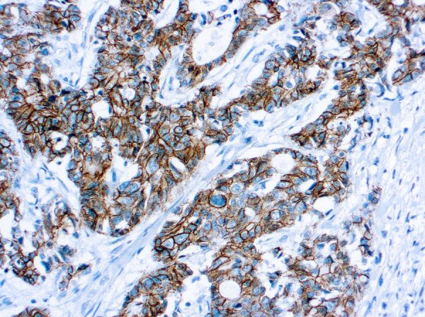 Immunohistochemical staining of p120 Catenin  of human FFPE tissue followed by incubation with HRP labeled secondary and development with DAB substrate.