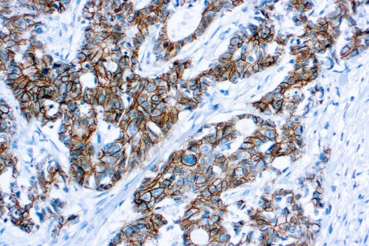 Immunohistochemical staining of p120 Catenin  of human FFPE tissue followed by incubation with HRP labeled secondary and development with DAB substrate.