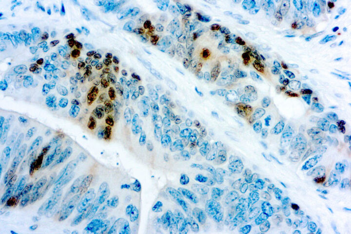 Immunohistochemical staining of p27Kip1  of human FFPE tissue followed by incubation with HRP labeled secondary and development with DAB substrate.