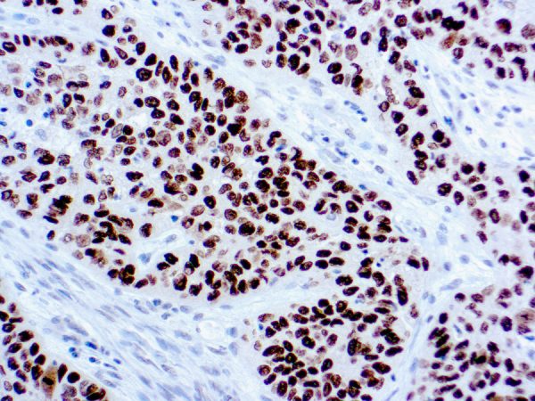 Immunohistochemical staining of p40  of human FFPE tissue followed by incubation with HRP labeled secondary and development with DAB substrate.