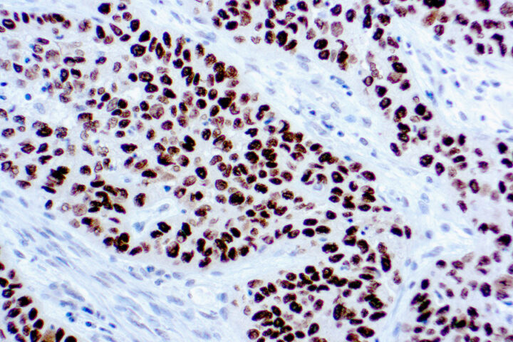 Immunohistochemical staining of p40  of human FFPE tissue followed by incubation with HRP labeled secondary and development with DAB substrate.