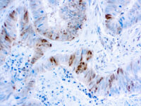 Immunohistochemical staining of p27Kip1  of human FFPE tissue followed by incubation with HRP labeled secondary and development with DAB substrate.