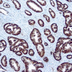 Immunohistochemical staining of p53  of human FFPE tissue followed by incubation with HRP labeled secondary and development with DAB substrate.