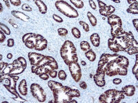 Immunohistochemical staining of p53  of human FFPE tissue followed by incubation with HRP labeled secondary and development with DAB substrate.