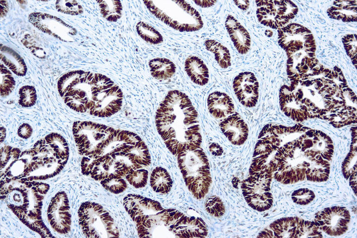 Immunohistochemical staining of p53  of human FFPE tissue followed by incubation with HRP labeled secondary and development with DAB substrate.