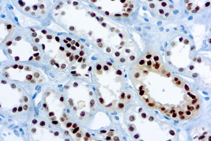 Immunohistochemical staining of Pax-8  of human FFPE tissue followed by incubation with HRP labeled secondary and development with DAB substrate.