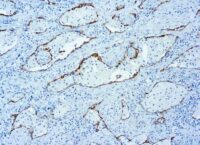 Immunohistochemical staining of PD1  of human FFPE tissue followed by incubation with HRP labeled secondary and development with DAB substrate.