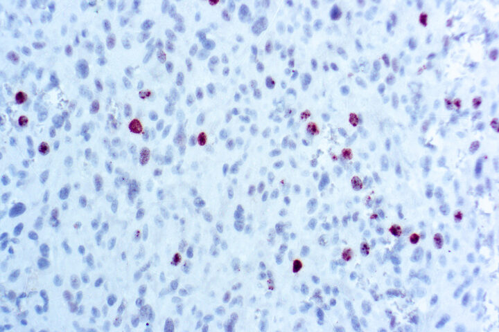 Immunohistochemical staining of Phosphohistone H3  of human FFPE tissue followed by incubation with HRP labeled secondary and development with DAB substrate.