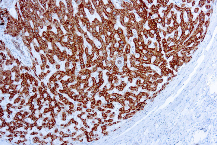 Immunohistochemical staining of Prohibitin  of human FFPE tissue followed by incubation with HRP labeled secondary and development with DAB substrate.