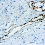 Immunohistochemical staining of Podoplanin  of human FFPE tissue followed by incubation with HRP labeled secondary and development with DAB substrate.