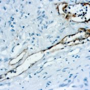 Immunohistochemical staining of Podoplanin  of human FFPE tissue followed by incubation with HRP labeled secondary and development with DAB substrate.