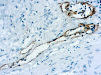 Immunohistochemical staining of Podoplanin  of human FFPE tissue followed by incubation with HRP labeled secondary and development with DAB substrate.