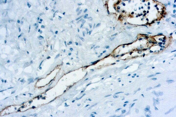 Immunohistochemical staining of Podoplanin  of human FFPE tissue followed by incubation with HRP labeled secondary and development with DAB substrate.